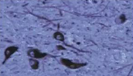 正常人：黑质神经元存在