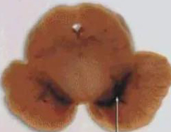 正常人：正常黑质