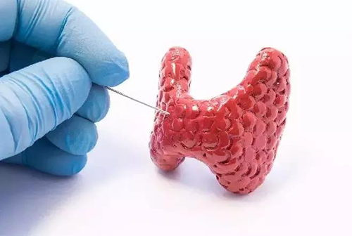 甲状腺疾。鬃聪俟δ芗跬撕图鬃聪俟δ芸航怨乓岳淳褪欠锤幢灰窖а芯咳嗽毖芯康募膊