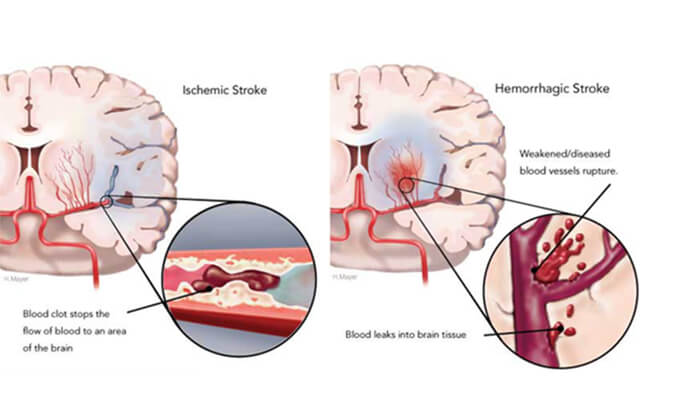 世界卒中日：从动物药效模型评价看心脑血管药物开发